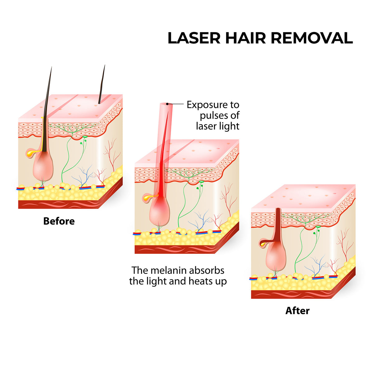 Xemos Laser Hair Remover W-808