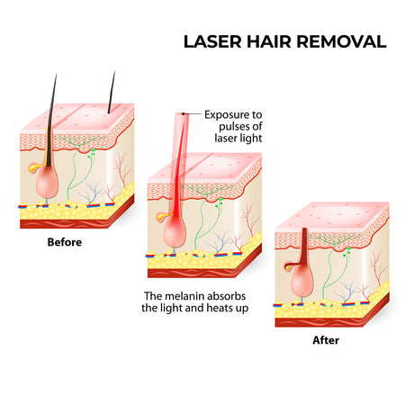 Xemos Laser Hair Remover W-808