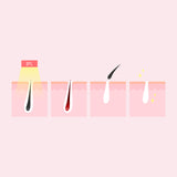 Xemos Laser Hair Remover W-808